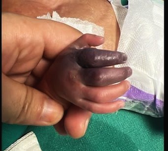 Newborn Set To Lose Hand After Hospital Gives Her Wrong Injection in……..